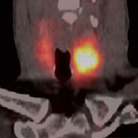 99mTc planar thyroid scan showing a cold left thyroid nodule | Download ...