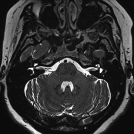 Mri Of Inner Ear Canal