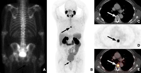 The Role Of Psma Pet Ct And Pet Mri In The Initial Staging Of Prostate