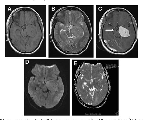 Figure From Differentiation Of Typical From Atypical And Malignant