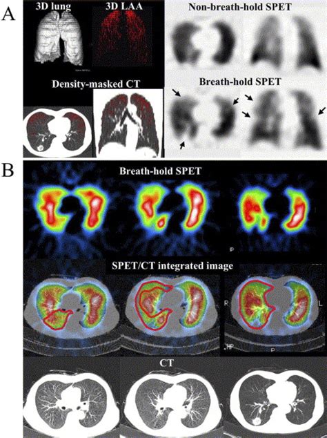 Breath Hold Single Photon Emission Tomography And Computed Tomography