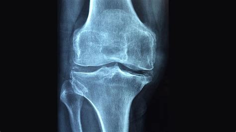 Osteoporoz Nedir Osteoporoz Belirtileri Neler