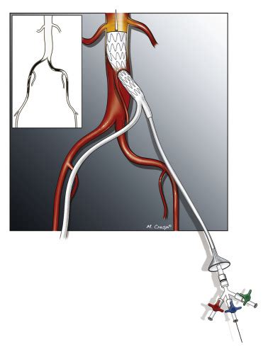 Is Endovascular Retroperitoneoscopic Aortobifemoral Bypass A Reasonable