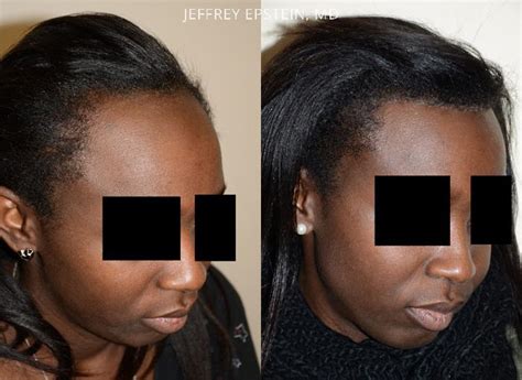 Forehead Reduction Surgery Photos Miami FL Patient37310