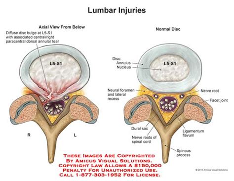 Lumbar Injuries