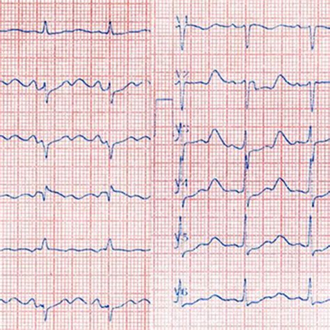 Lead Electrocardiogram Revealed Normal Sinus Rhythm With Prolonged