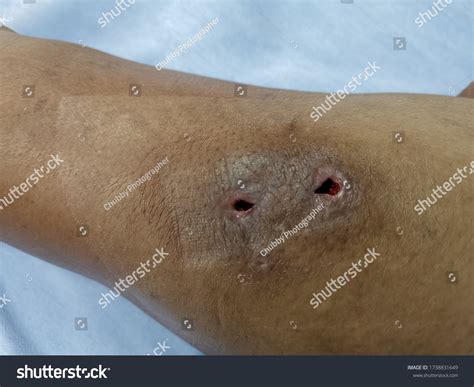 1,406 Human Bite Wound Infection Images, Stock Photos & Vectors ...