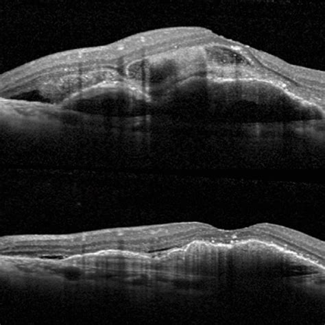 Comparison Of Subretinal Versus Intravitreal Injection Of Recombinant