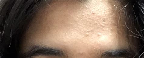 [skin Concern] Weird Tiny Bumps On Forehead And Some On Cheeks How Do