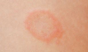 Mild Ringworm