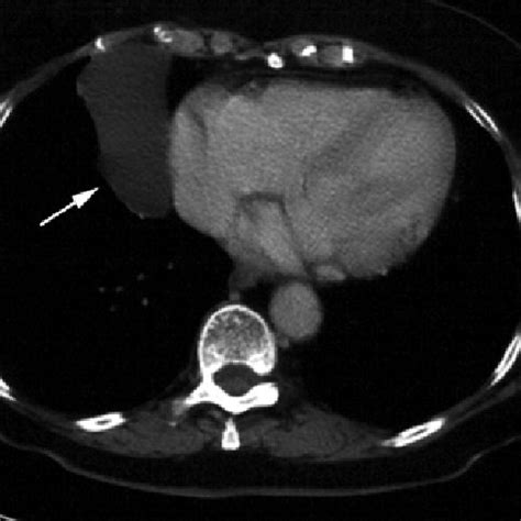 Contrast Enhanced Computed Tomographic Scan Of The Chest With