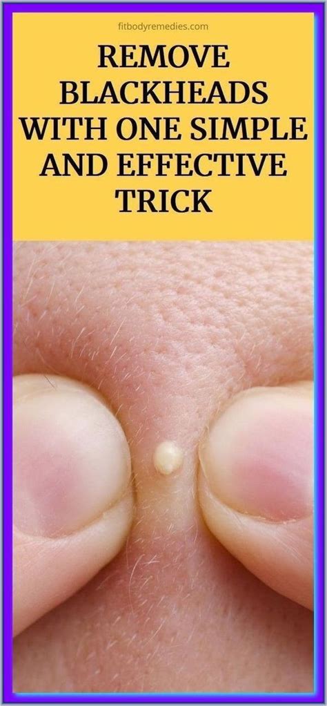 Effective Trick To Remove Blackheads