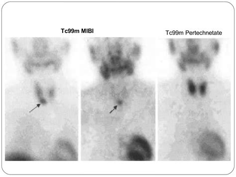 Radionuclide Imaging Thyroid And Parathyroid