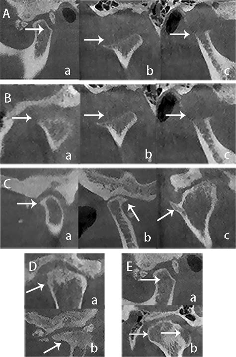 Imaging Features Of Temporomandibular Joint Synovial Chondromatosis