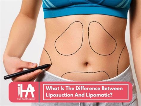 What Is The Difference Between Liposuction And Lipomatic Iran Health Agency