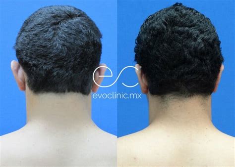 Ear Reshaping | Before and After | evoclinic