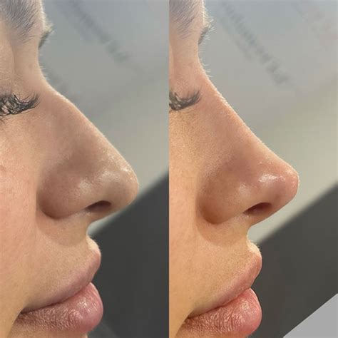 Non Surgical Rhinoplasty In Colchester Essex Nose Filler Enhance