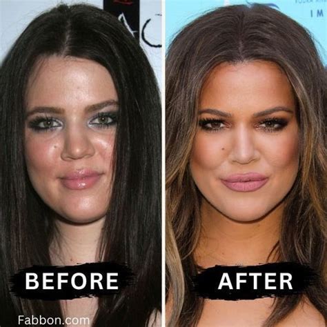 17 Celebrities Who Have Had Buccal Fat Removal - 2024 | Fabbon