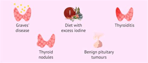 Causes of hyperthyroidism