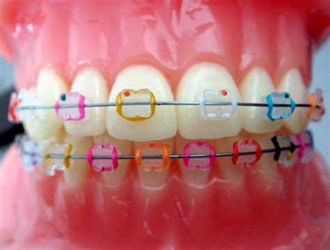 Ceramic Braces With Colored Bands