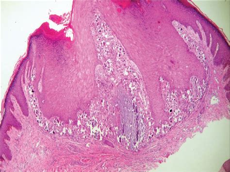 Subepidermal Calcified Nodule In Upper Eyelid A Case Report And Review