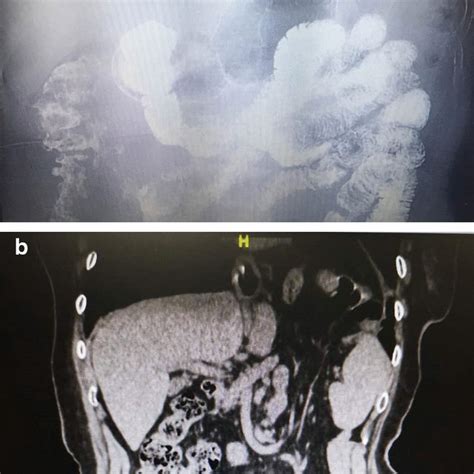 Cumulative Probabilities Of Hiatal Hernia Recurrence Calculated For The