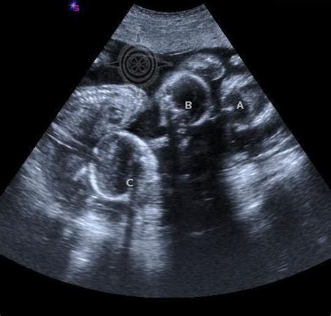 Triplets Ultrasound 20 Weeks