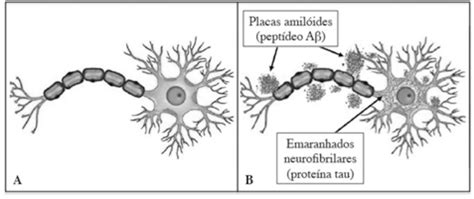 Alzheimer Mais Uma Descoberta Na Fisiopatologia Explore As Melhores