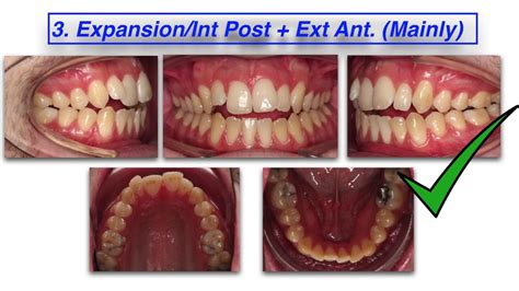 Invisalign Tads To Solve An Openbite Malocclusion Youtube