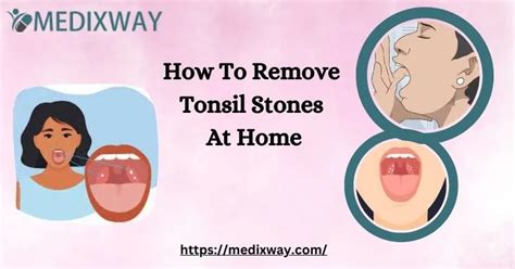 how to remove tonsil stones at home