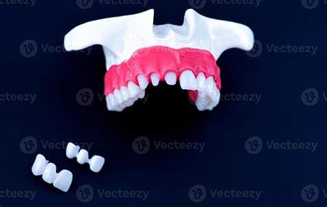 Tooth implant and crown installation process 11258381 Stock Photo at ...