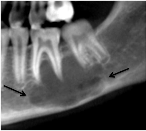 Traumatic Bone Cyst Jaw