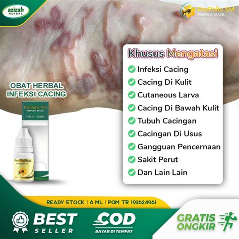 Jual Obat Cutaneous Larva Migrans Cacing Kulit Infeksi Lava Cacing