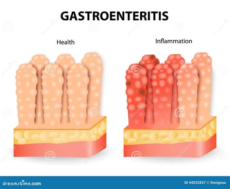 Gastroenteritis Or Infectious Diarrhea Stock Vector Illustration Of