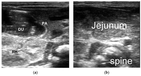 Diagnostics Free Full Text Ultrasonic Diagnosis Of Intestinal