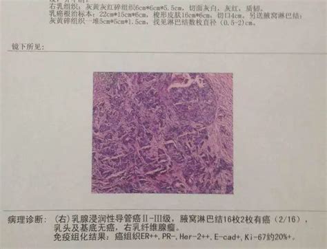 一文读懂：乳腺癌病理报告 腾讯新闻