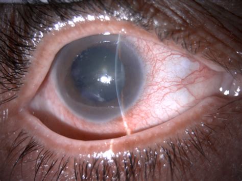 Olanzapine Induced Acute Angle Closure Glaucoma