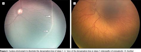 Figure 1 From The International Classification Of Retinopathy Of Prematurity Revisited