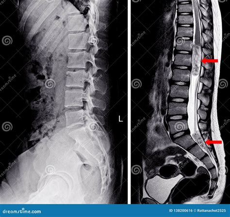 X-ray and MRI Lumbar spine stock illustration. Illustration of hospital