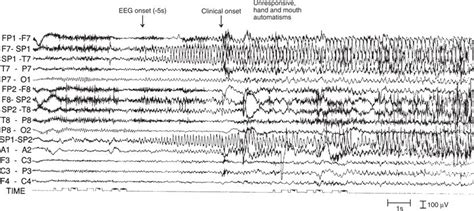 Focal Seizures with Impaired Consciousness | Neupsy Key