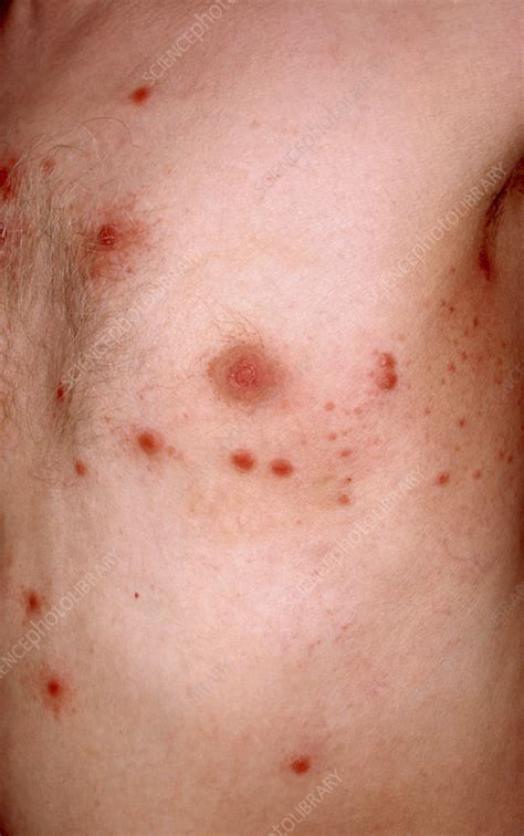 Secondary Syphilis Rash On A Man S Chest Stock Image C058 5732