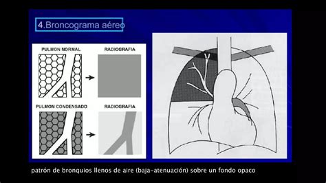 Patologia De Torax Radiologica Ppt