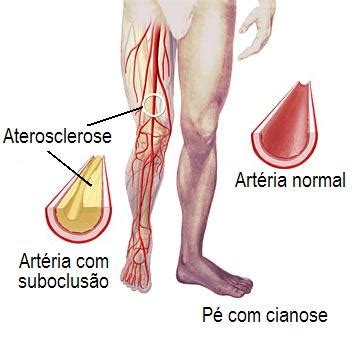 Consultoria De Enfermagem Mendes Hernandez Gordura No Sangue O Mal