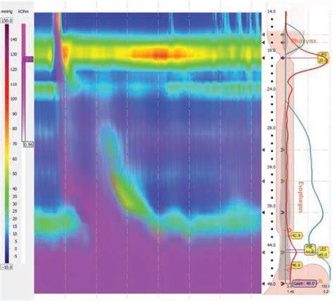 Pdf Ab High Resolution Impedance Manometry In Dermatomyositis