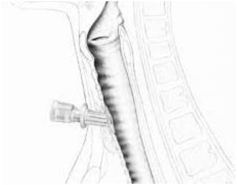 Use Of A Silicon Stoma Stent As An Interim Step In High Risk