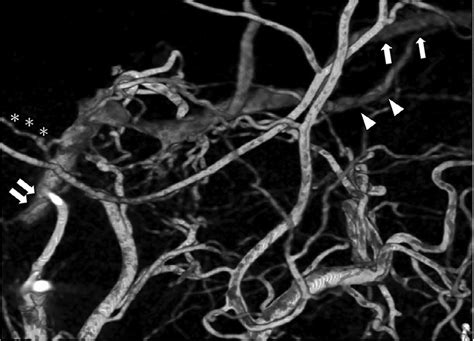 Right External Carotid 3d Rotational Angiography Lateral Right Eca 3d