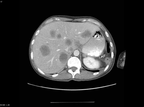 Pancreatic Cancer With Multiple Liver Metastases Radrounds Radiology Network