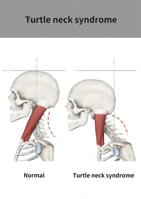 Turtle Neck Syndrome: Exercises, Causes and Symptoms - VAUNTE