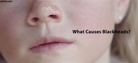 What Causes Blackheads? | How to Treat Blackheads | Sehat