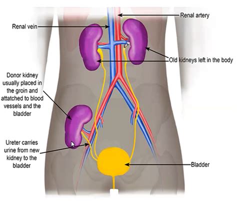 Kidney Transplantation Flashcards Quizlet